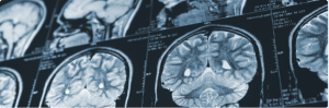 Traumatic Brain Injuries