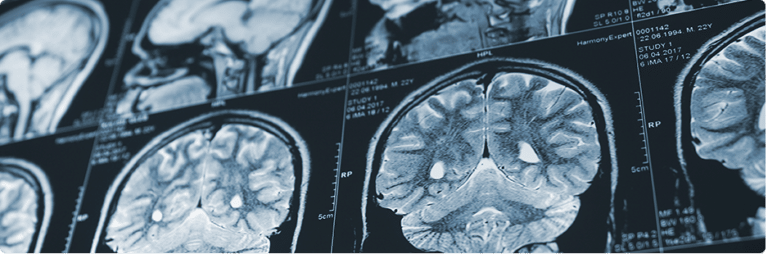 Traumatic Brain Injuries